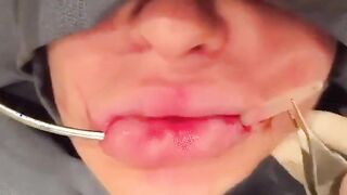 Bolted on lips surgery lip implants